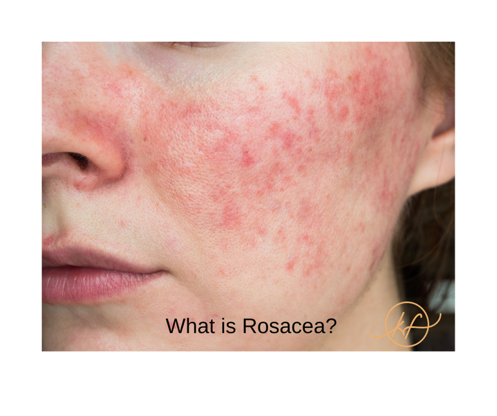Acne Rosacea and SIBO